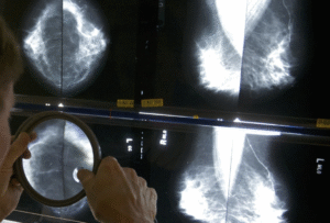 Advanced cancers returned to prepandemic levels, according to a reassuring report